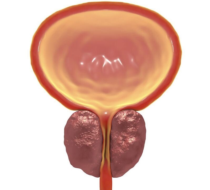 Inflamación da prostatite crónica