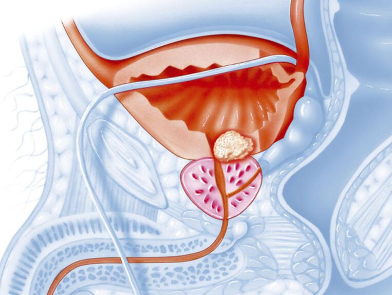 Síntomas da prostatite crónica